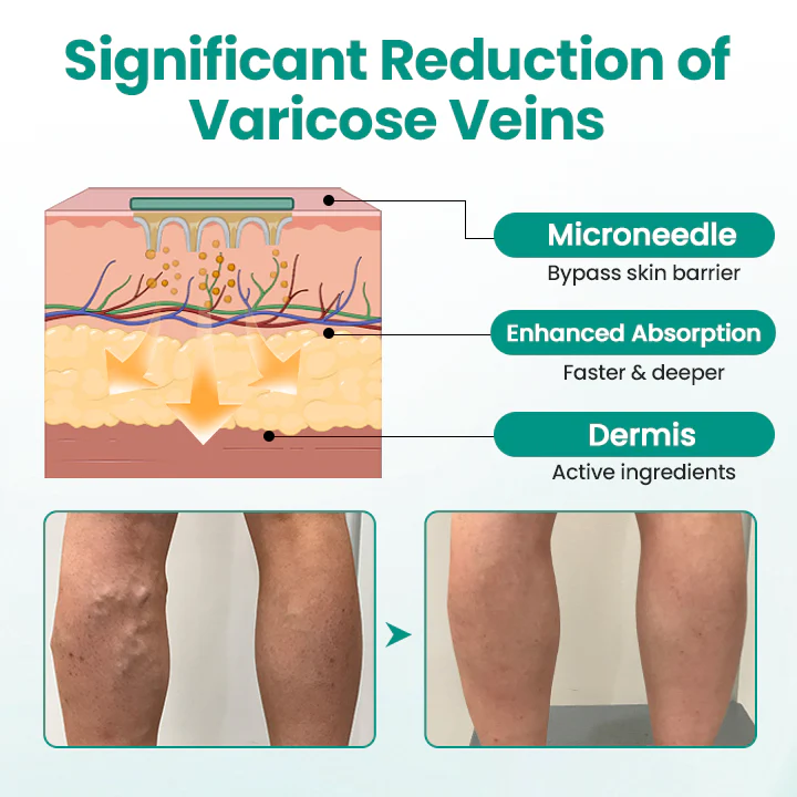 Healrize® LegRenew Varicose Veins Patch✨ - Image 3